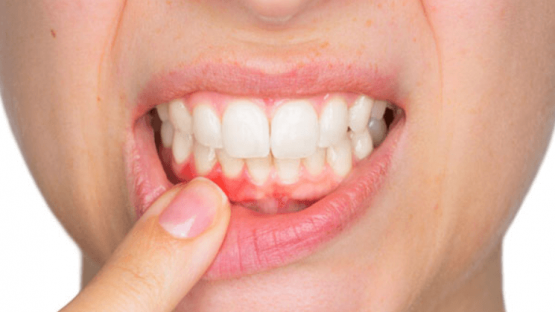 Viêm nướu chân răng uống thuốc gì an toàn và hiệu quả?