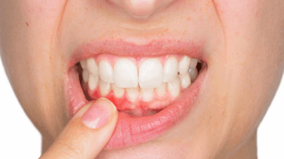 Viêm nướu chân răng uống thuốc gì an toàn và hiệu quả?