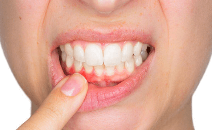 Viêm nướu chân răng xảy ra do mảng bám, vi khuẩn tích tụ lâu ngày