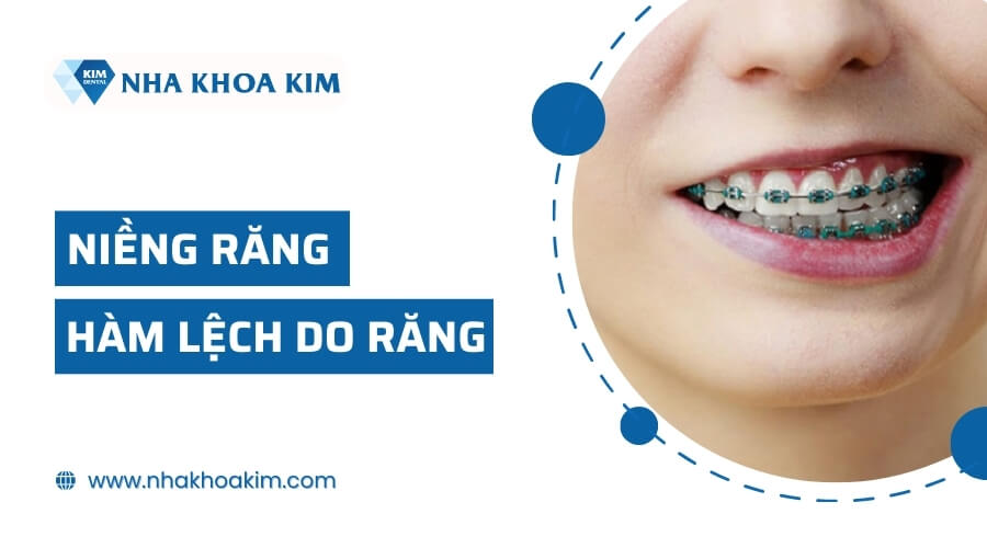 Niềng răng chỉnh lệch hàm