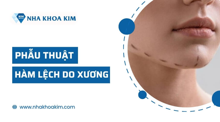 Phẫu thuật chỉnh lệch hàm