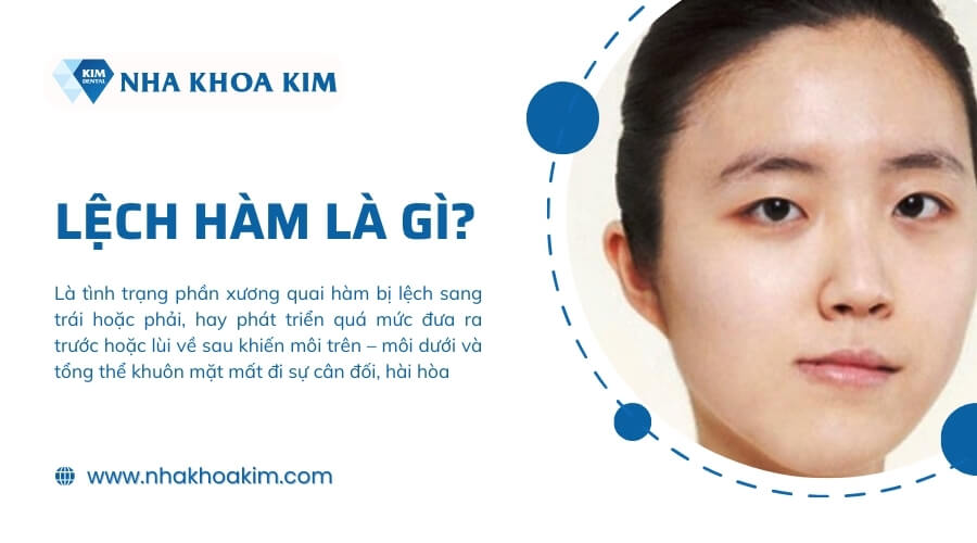 Lệch hàm là gì?