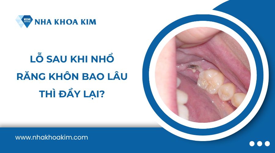 Lỗ sau khi nhổ răng khôn bao lâu thì đầy lại?