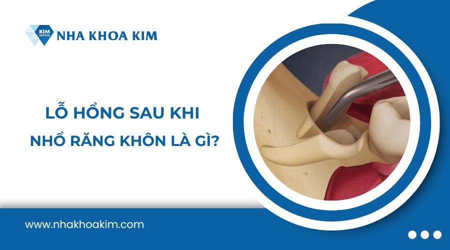 Lỗ hổng sau khi nhổ răng khôn là gì?