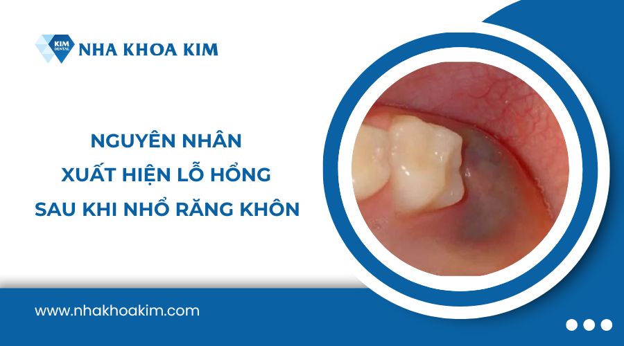 Nguyên nhân xuất hiện lỗ sau khi nhổ răng khôn