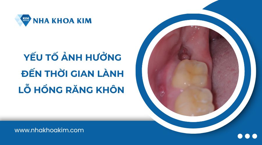 Yếu tố ảnh hưởng đến thời gian lành lỗ hổng răng khôn