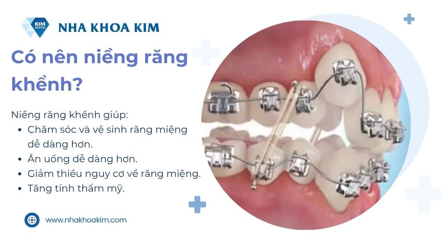 Có nên niềng răng khểnh không?