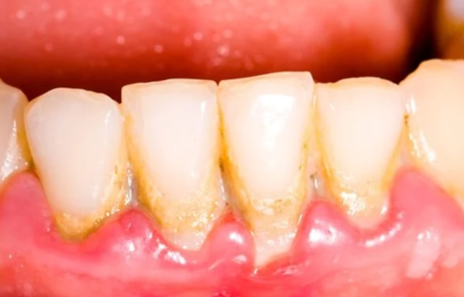 Vì sao nên thường xuyên lấy cao răng?