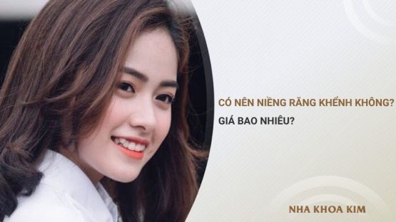 Có nên niềng răng khểnh không? Giá bao nhiêu?