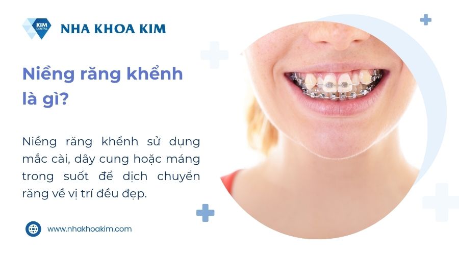 Răng khểnh là gì?