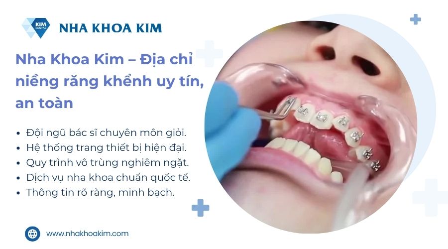 Quy trình niềng răng khểnh tại Nha Khoa Kim