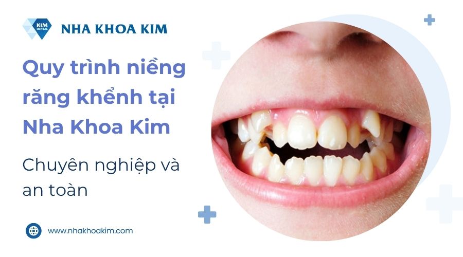 Quy trình niềng răng tại Nha Khoa Kim
