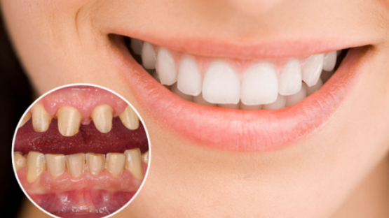 So sánh răng toàn sứ Zircomax & Cercon HT: Loại nào tốt hơn?