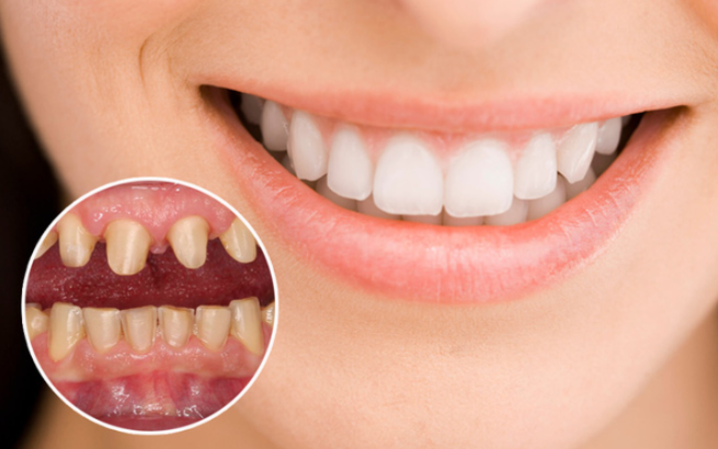 Răng toàn sứ Zircomax là răng sứ sườn phôi sứ chính hãng