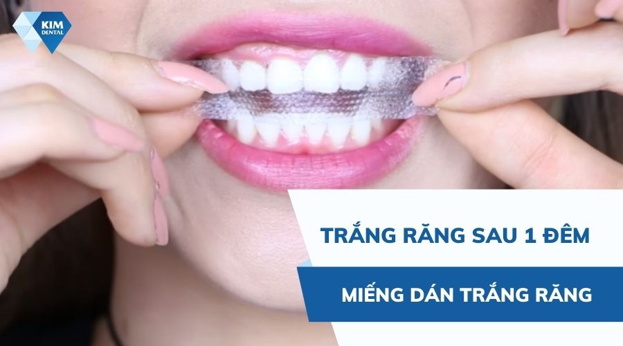 tẩy trắng răng sau 1 đêm với miếng dán trắng răng