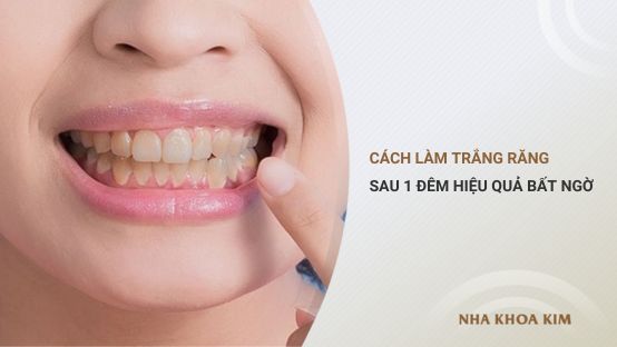 Mách bạn cách làm trắng răng sau 1 đêm hiệu quả bất ngờ