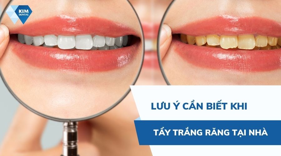 Lưu ý khi tẩy trắng răng tại nhà 