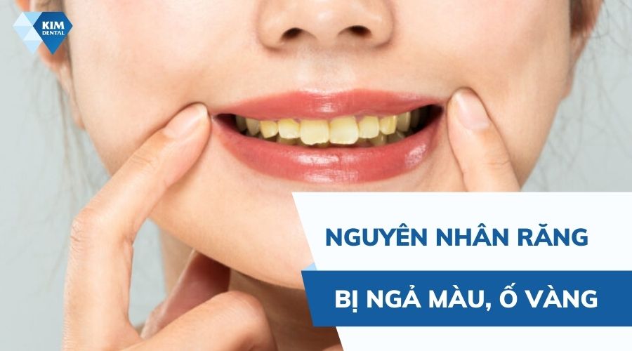 nguyên nhân khiến răng bị ngả màu