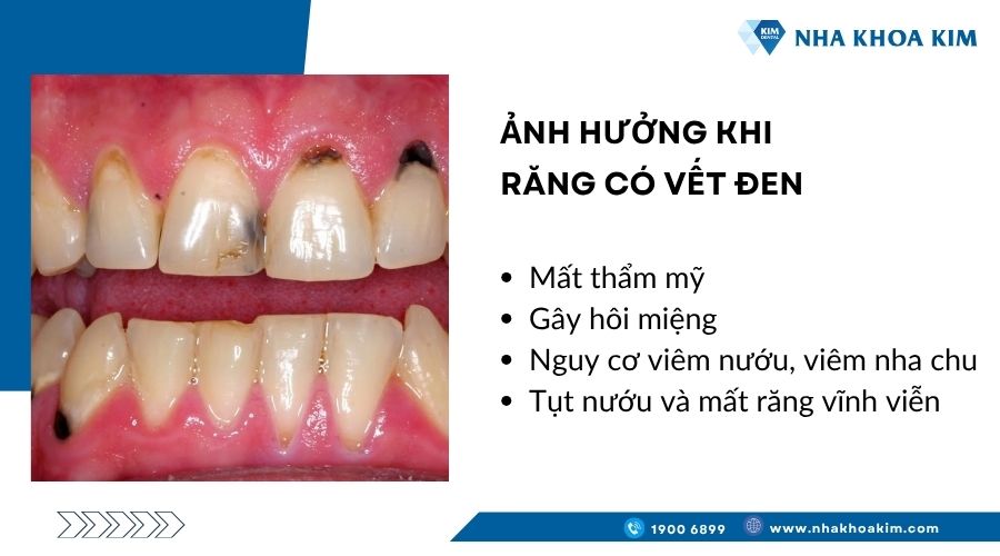 Ảnh hưởng khi răng có vết đen