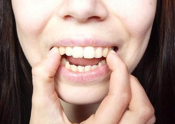 Bọc răng sứ có thể khắc phục những trường hợp hô nhẹ