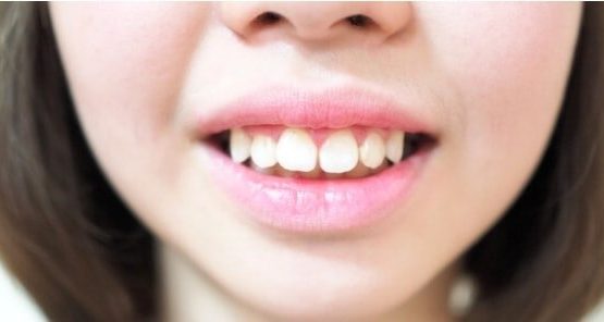 Bọc răng sứ cho răng hô – Giải pháp lấy lại nụ cười xinh tại Nha Khoa Kim