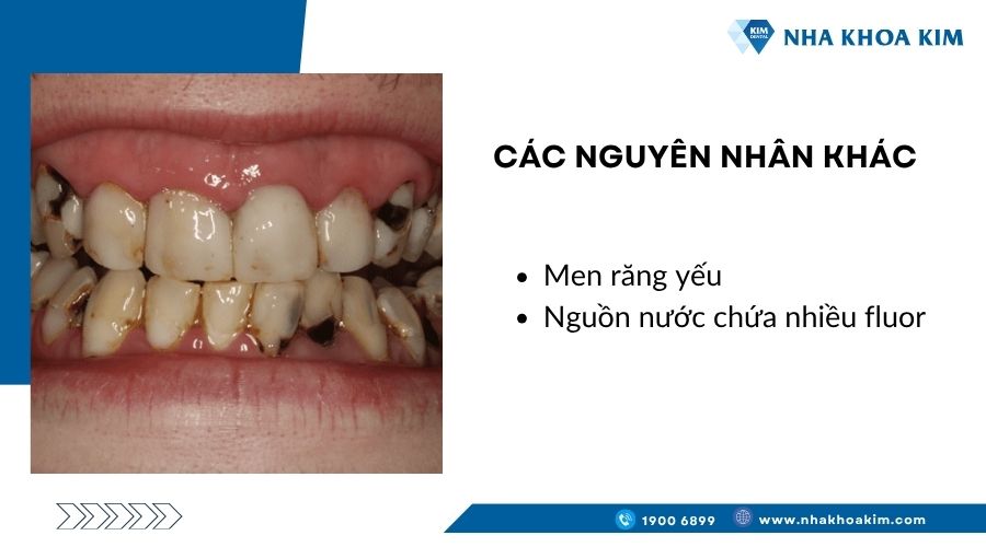 Các nguyên nhân khác khiến răng xuất hiện vết đen
