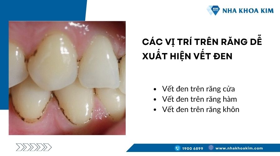 Các vị trí trên răng dễ xuất hiện vết đen