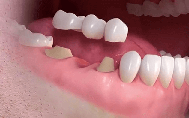 Trồng răng giả giúp giải quyết tình trạng mất răng