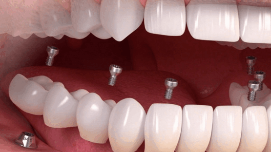 Chi phí làm răng giả cố định tại Nha Khoa Kim bao nhiêu?