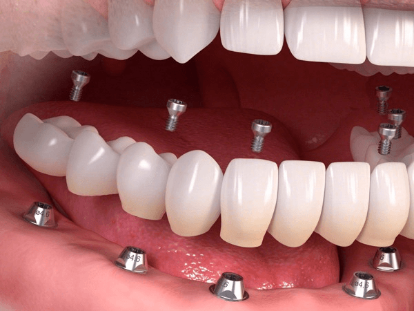 Chi phí làm răng giả cố định tại Nha Khoa Kim bao nhiêu?