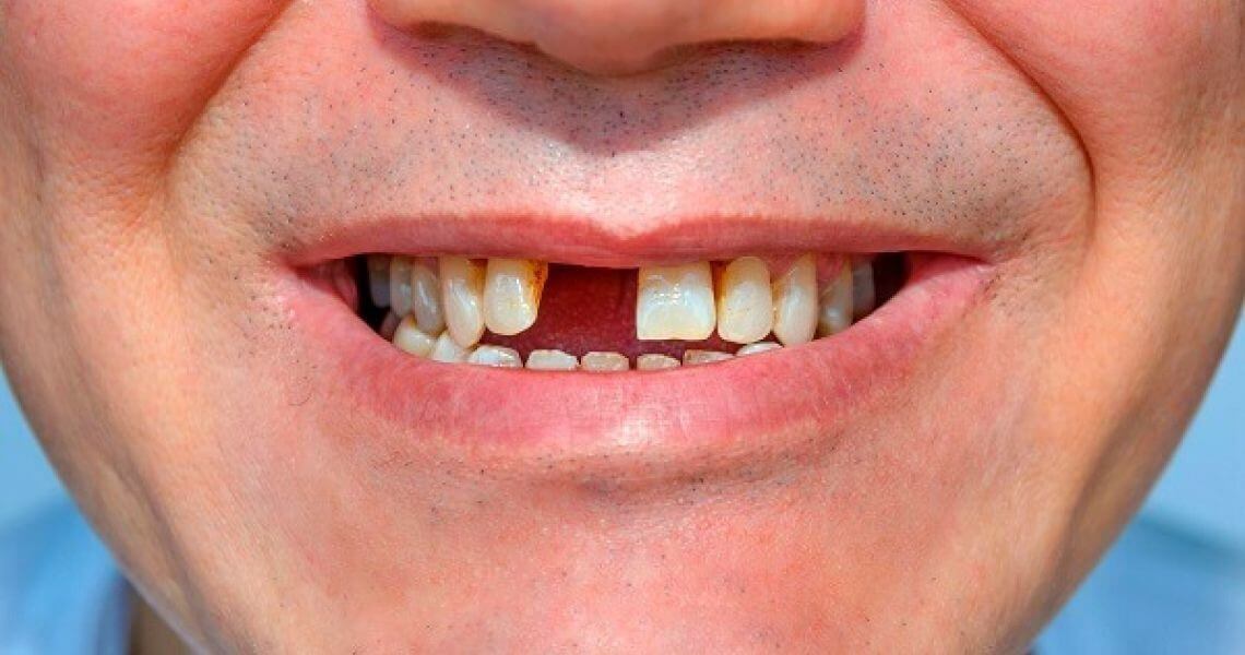 Chi phí làm răng giả phụ thuộc vào số lượng răng cần làm