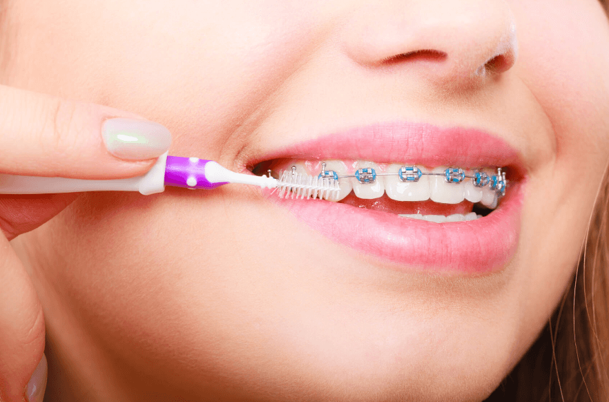 Chăm sóc răng miệng đúng cách sau khi niềng răng