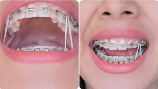 Niềng răng và những điều cần biết trước – sau khi niềng răng