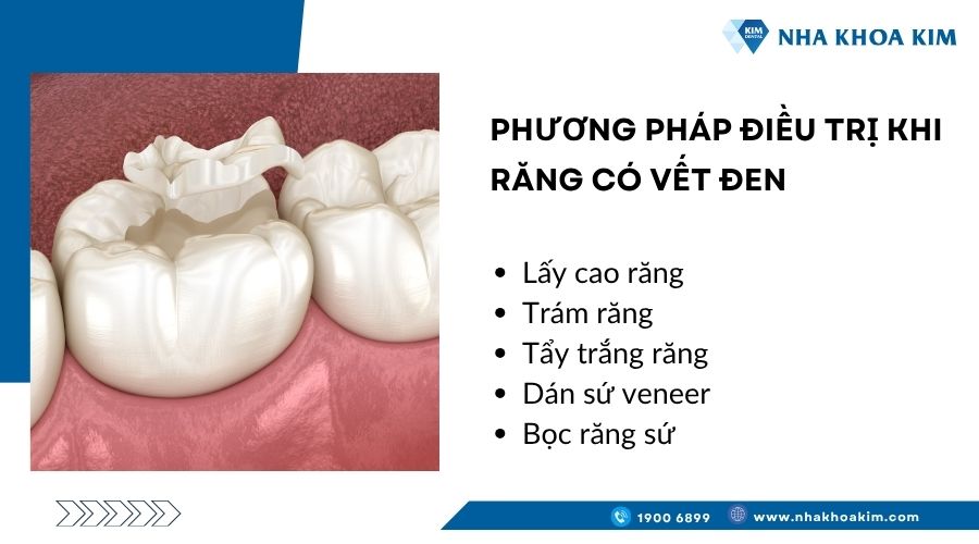 Phương pháp điều trị khi răng có vết đen