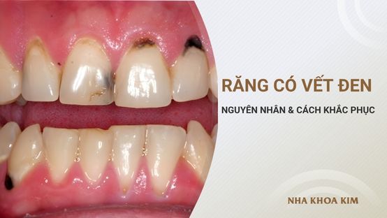 Răng có vết đen: Nguyên nhân và cách khắc phục hiệu quả