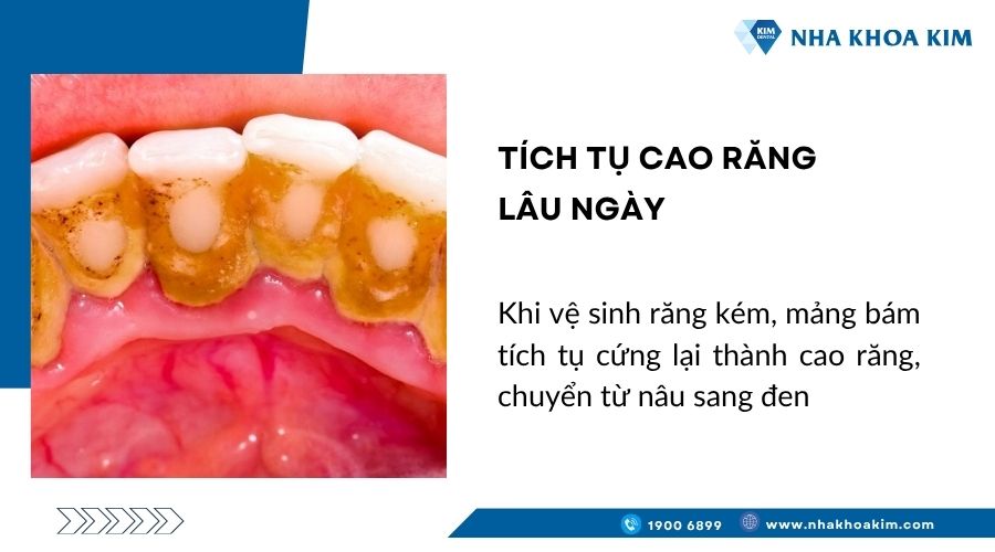 Tích tụ cao răng lâu ngày