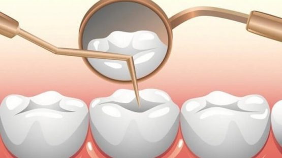 Trám răng sâu có đau không? Địa chỉ trám răng sâu hiệu quả, an toàn 