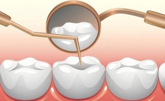 Trám răng sâu có đau không? Địa chỉ trám răng sâu hiệu quả, an toàn