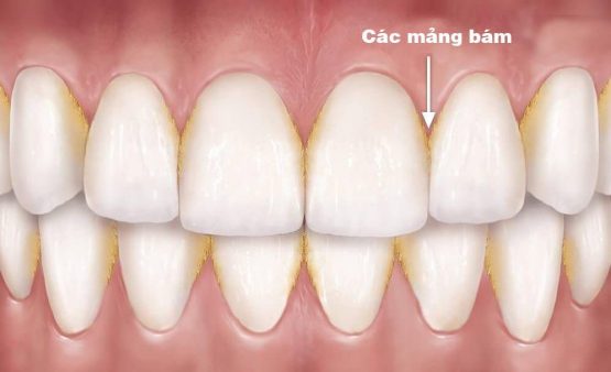 Triệu chứng viêm nha chu răng và cách điều trị tại Nha Khoa Kim
