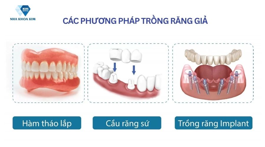 Tổng hợp phương pháp làm răng giả cố định