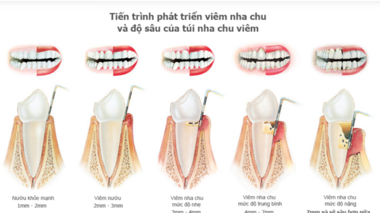 Dịch vụ điều trị viêm nha chu răng lung lay tại Nha Khoa Kim