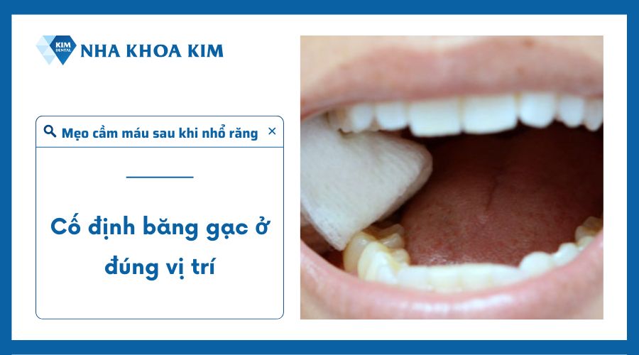 Mẹo cầm máu sau khi nhổ răng an toàn, hiệu quả