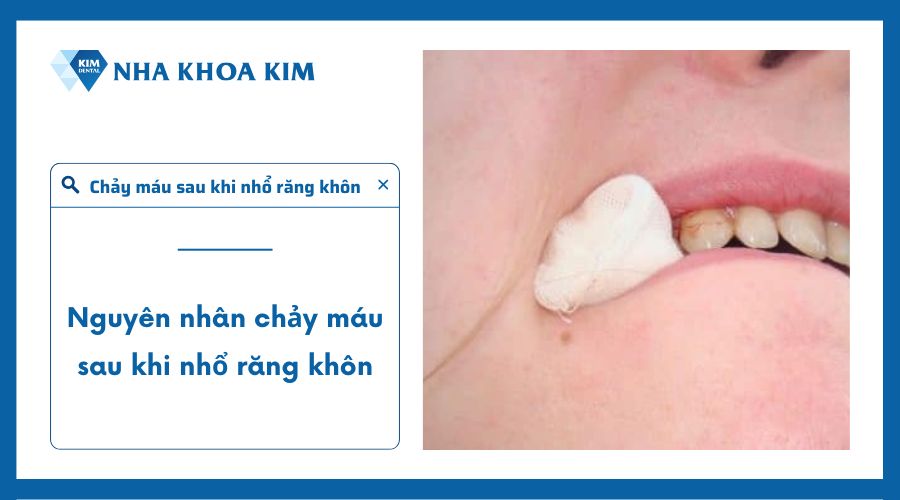 Tại sao chảy máu liên tục sau khi nhổ răng?
