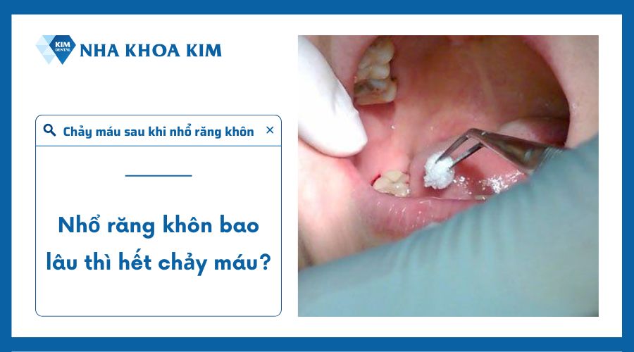 Nhổ răng bao lâu thì hết chảy máu?
