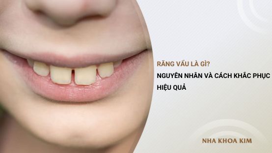 Răng vẩu là gì? Nguyên nhân và cách khắc phục hiệu quả