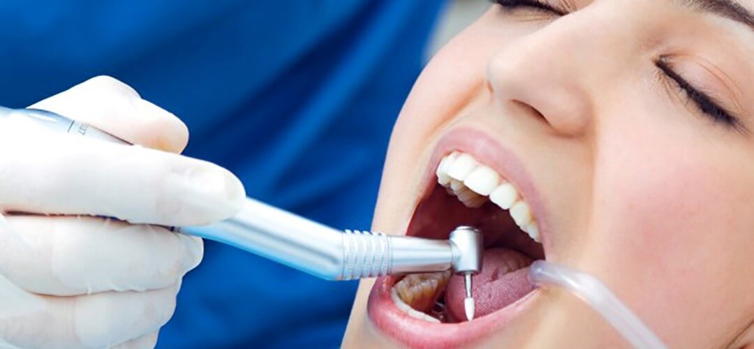 Nên điều trị áp xe răng tận gốc để tránh tái lại