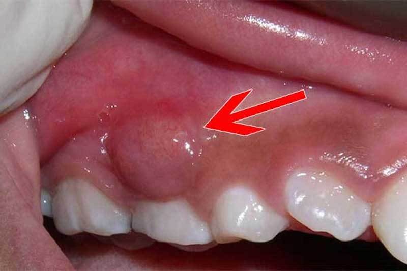 Áp xe răng là gì? Dấu hiệu, nguyên nhân & cách điều trị hiệu quả