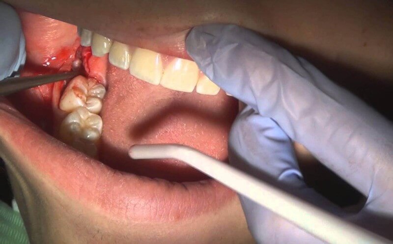 Điều trị cấp cho áp xe răng