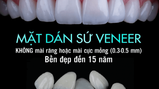 Giá răng sứ Veneer bao nhiêu cập nhật mới nhất hiện nay