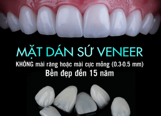 Giá răng sứ Veneer bao nhiêu cập nhật mới nhất hiện nay
